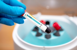 prp behandling plasmolifting