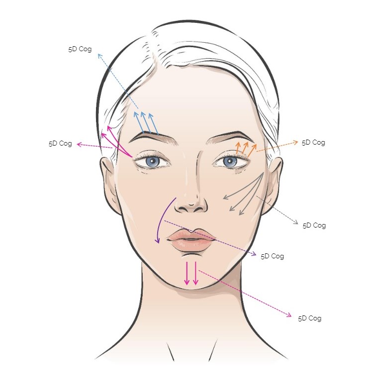 Rainbow Threads Rainbow 5G Cog 4x draadlift dermal filler oreon life science explanation 2